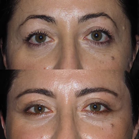 Blepharoplasty in Dubai