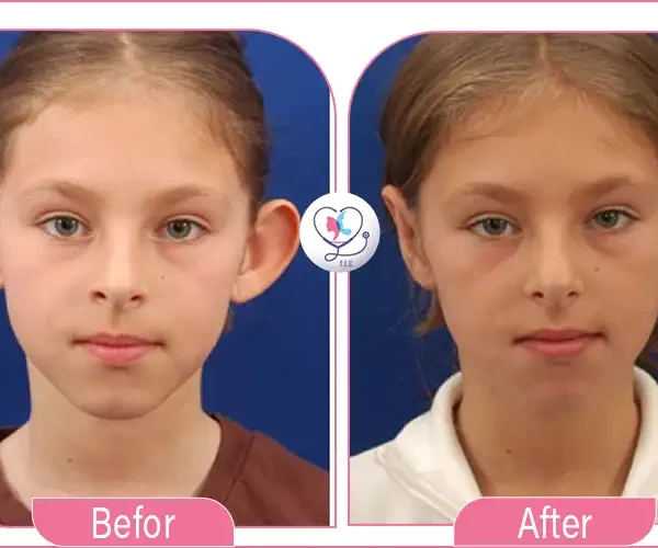 Ear Surgery (Otoplasty): Complete Guide to Ear Reshaping, Recovery, Cost & Results