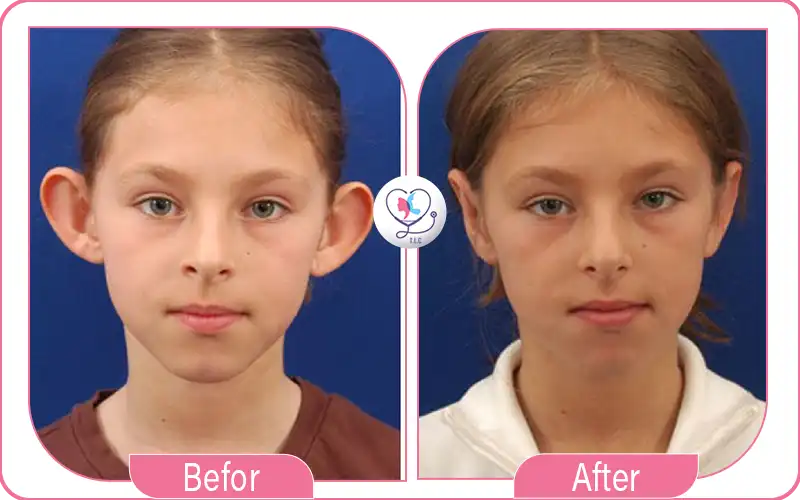 Ear Surgery (Otoplasty): Complete Guide to Ear Reshaping, Recovery, Cost & Results
